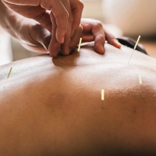 Acupuncture on a person's back